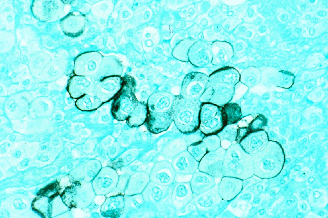 Microscopy image of human tumor cells from the pancreas with an immunocytochemical stain